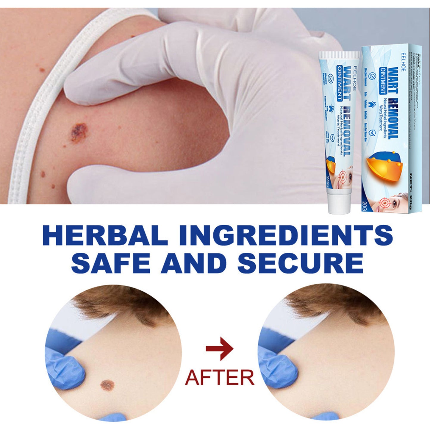 EELHOE Wart & Skin Tag Removal Cream – Herbal Skin Repair for Hands, Feet, Face & Underarms